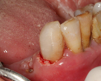 尽量保留自己的残冠一例 - 好大夫在线