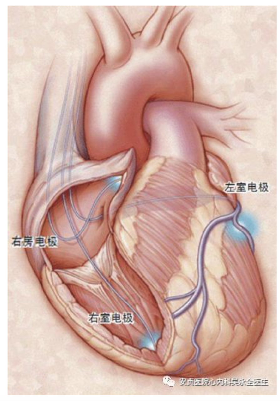 擴張性心肌病心力衰竭與心臟再同步化治療