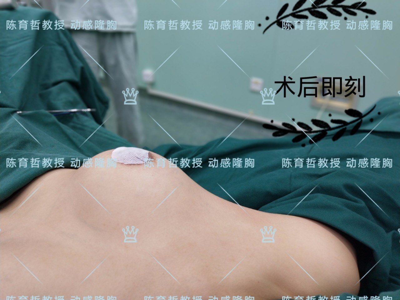 动感隆胸案例(35)不对称乳腺萎缩后的假体治疗