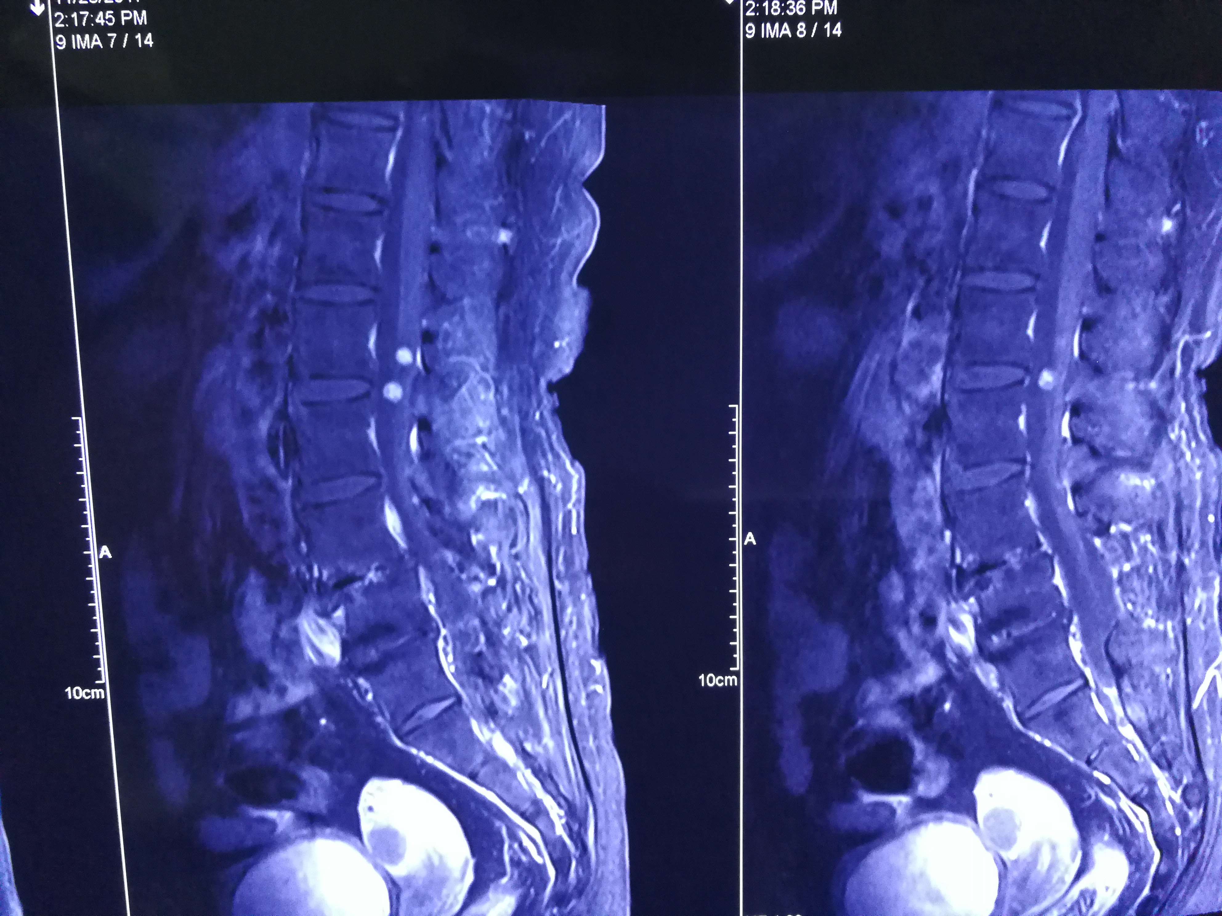 腰椎神经鞘瘤图片