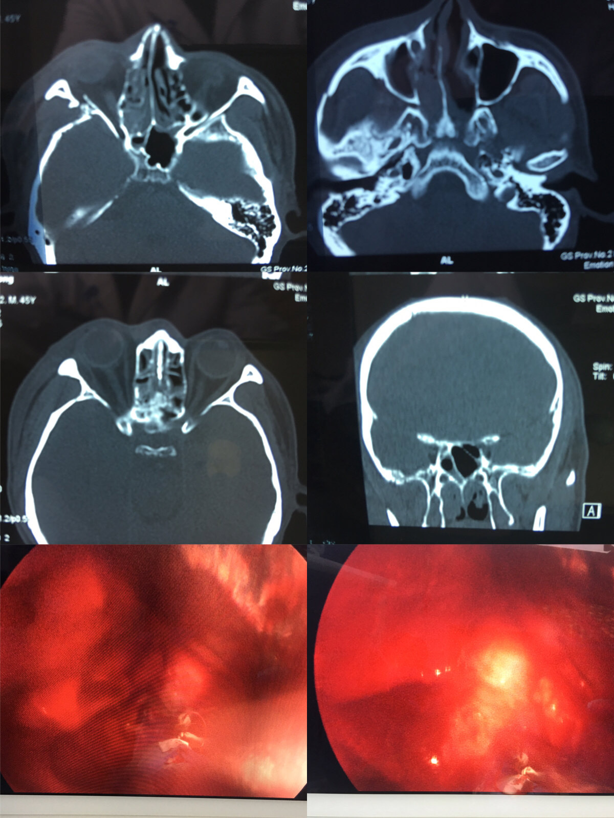 眼眶骨折整复并视神经管减压术 - 好大夫在线