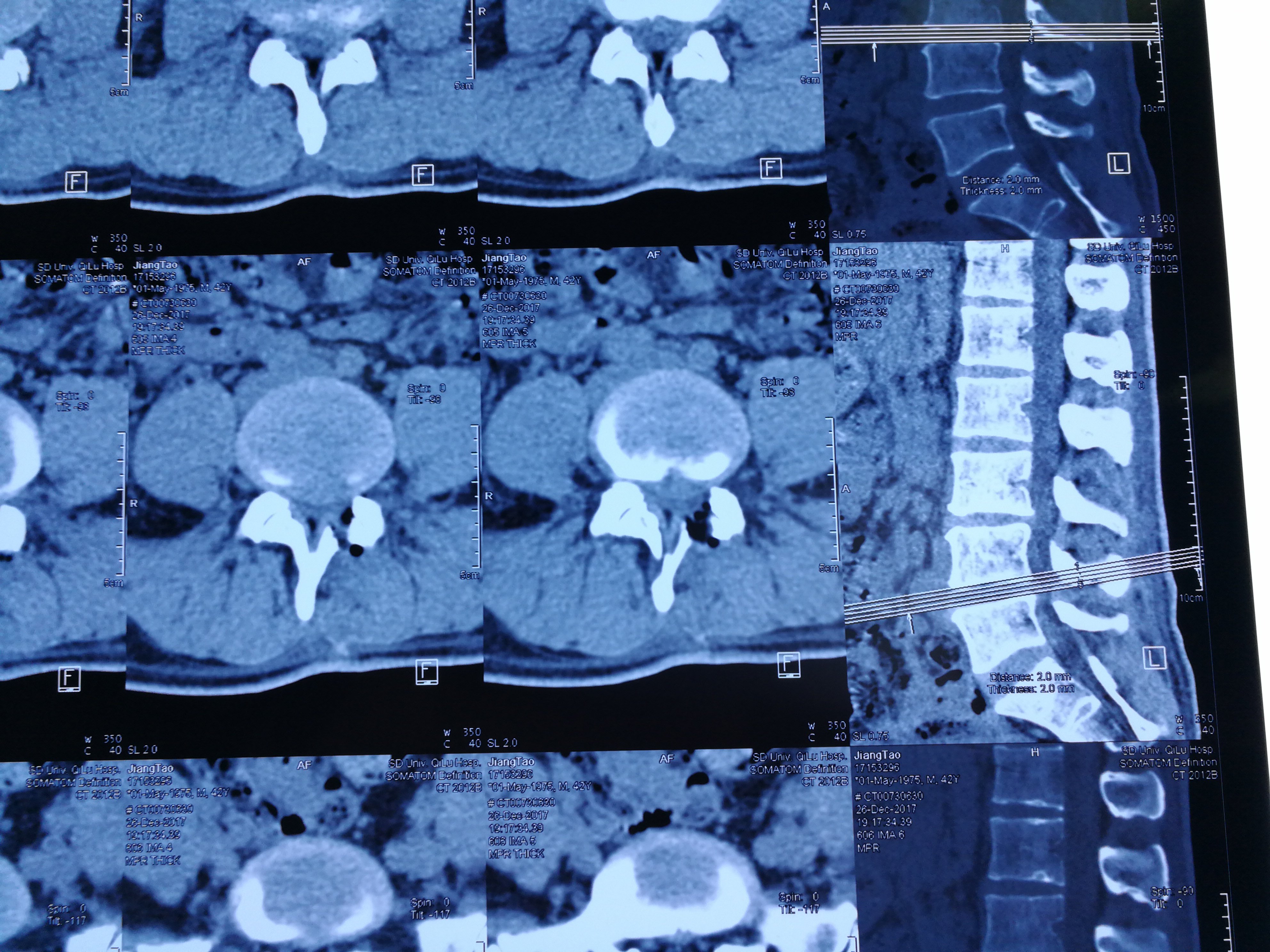 腰椎间盘突出的视频锻炼_腰椎间盘突出症的锻炼方法视频(流畅)_适合腰椎间盘突锻炼的视频