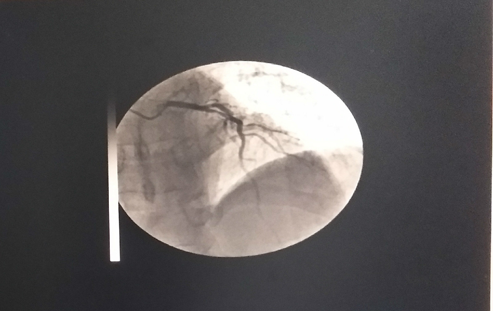 急性心肌梗死前降支植入支架一例 - 好大夫在线