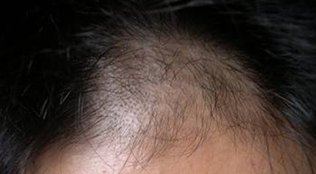 这种脱发竟然是梅毒