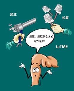 医生患者的直肠癌能保肛吗