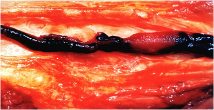 13.骨折后下肢深静脉血栓形成如何预防?_下肢静脉血栓_预防_疾病介绍 