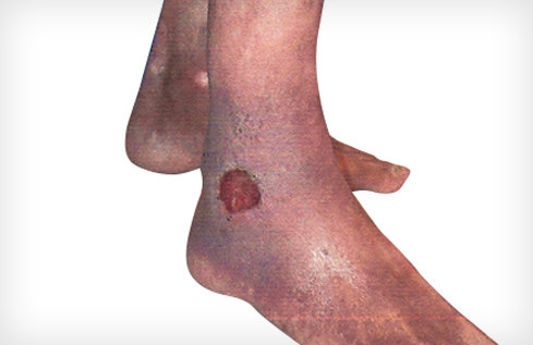 下肢静脉曲张的严重危害 - 好大夫在线