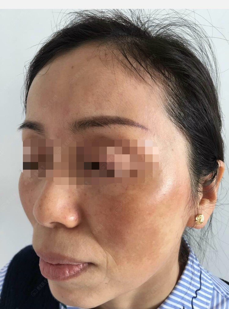 一,病因:黄褐斑是一种面部获得性色素增加性皮肤病,多发生于频繁暴露