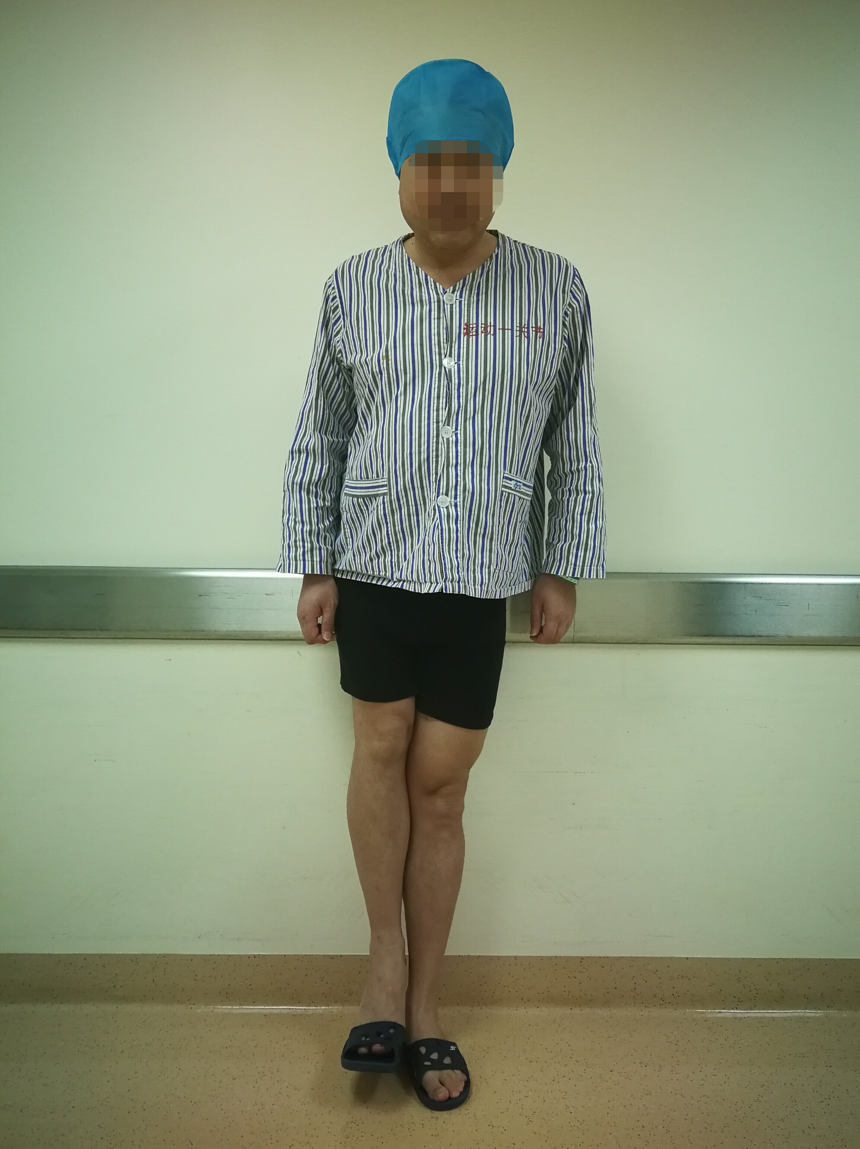 46岁男患,既往结核,强直屈曲短缩畸形,疼痛跛行,全髋置换术.