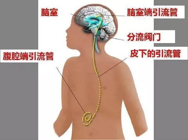 脑室-腹腔分流术治愈交通性脑积水一例