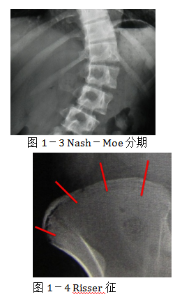 脊柱侧弯的分类 - 脊柱侧凸分类 - 实验室设备网