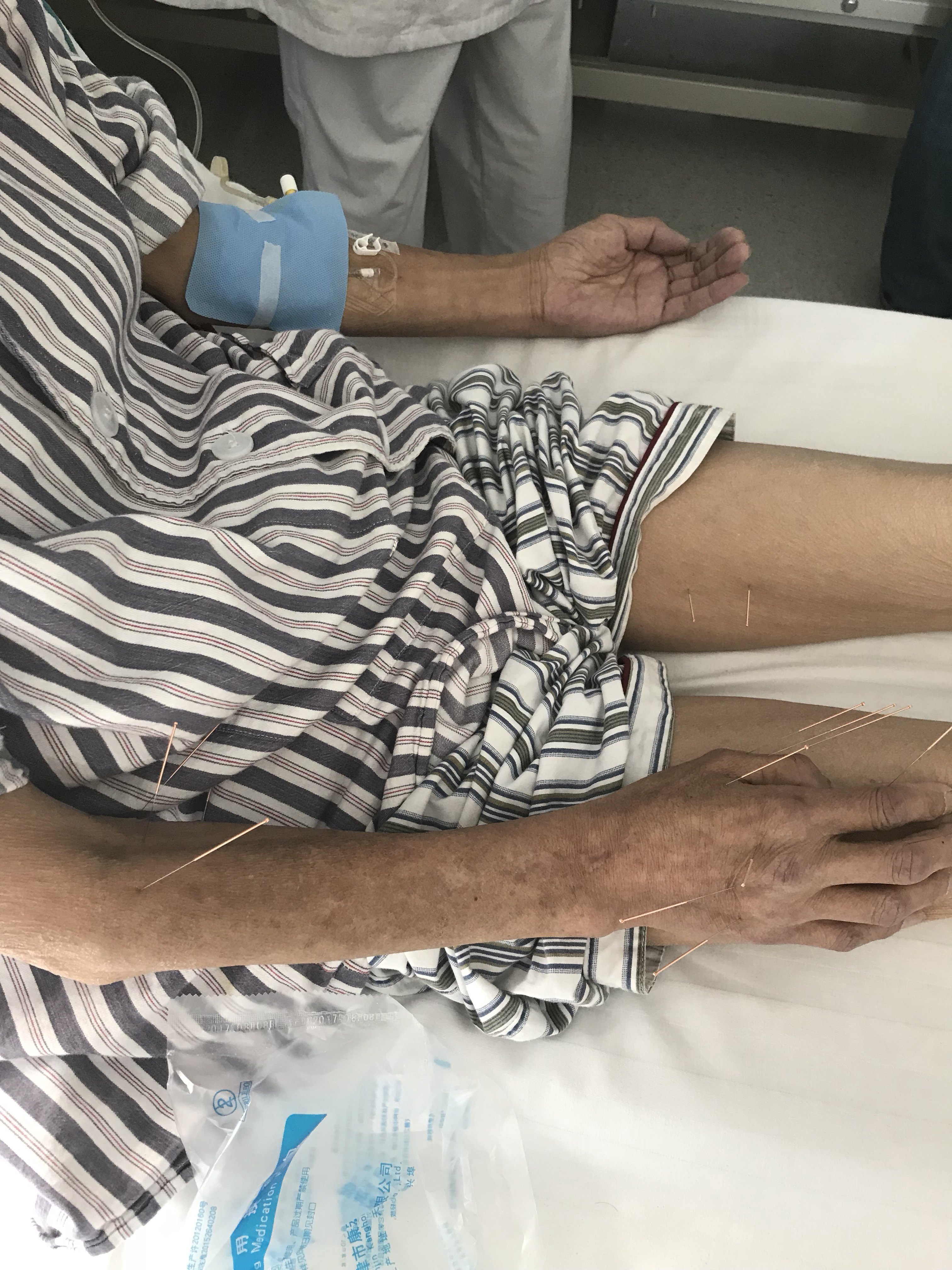 针灸治疗癌痛 - 好大夫在线