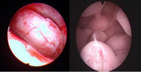 子宫内膜息肉的临床意义和手术时机_子宫内膜息肉_疾病介绍_手术_介绍