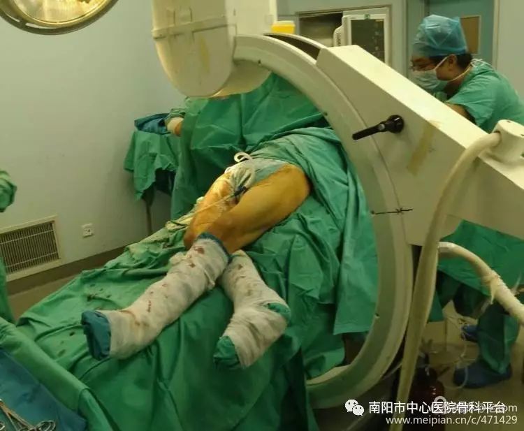 典型病例直接前入路微创髋关节置换术daa