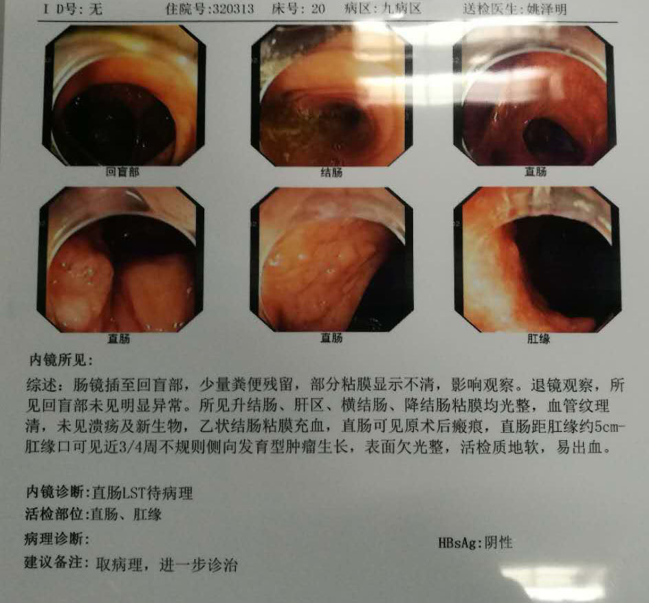 直腸癌保肛術後再發直腸腫瘤行再次保肛手術