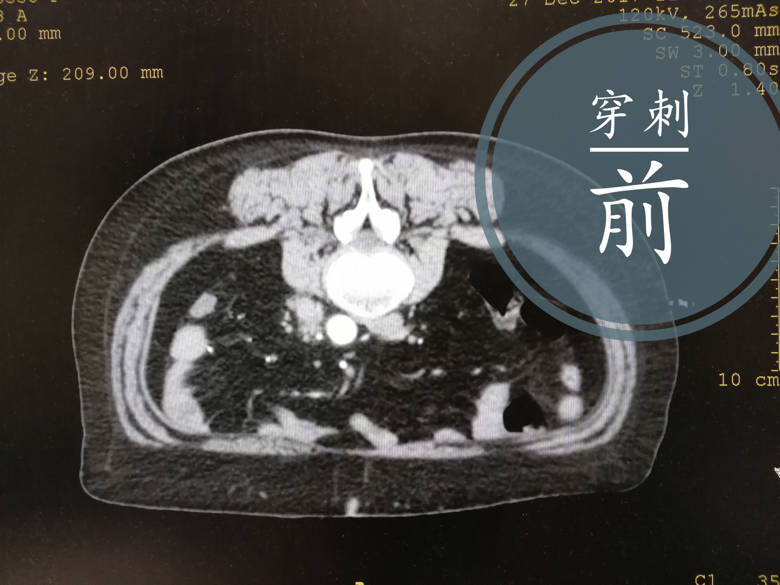 腹主动脉旁淋巴结穿刺活检 - 好大夫在线