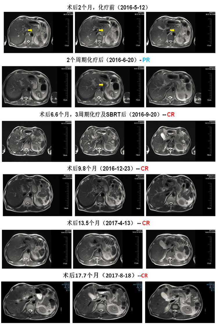 腹膜後腫塊mri圖像變化如下圖所示:二,診療經過圖1:腹部mri:腹腔,腹膜