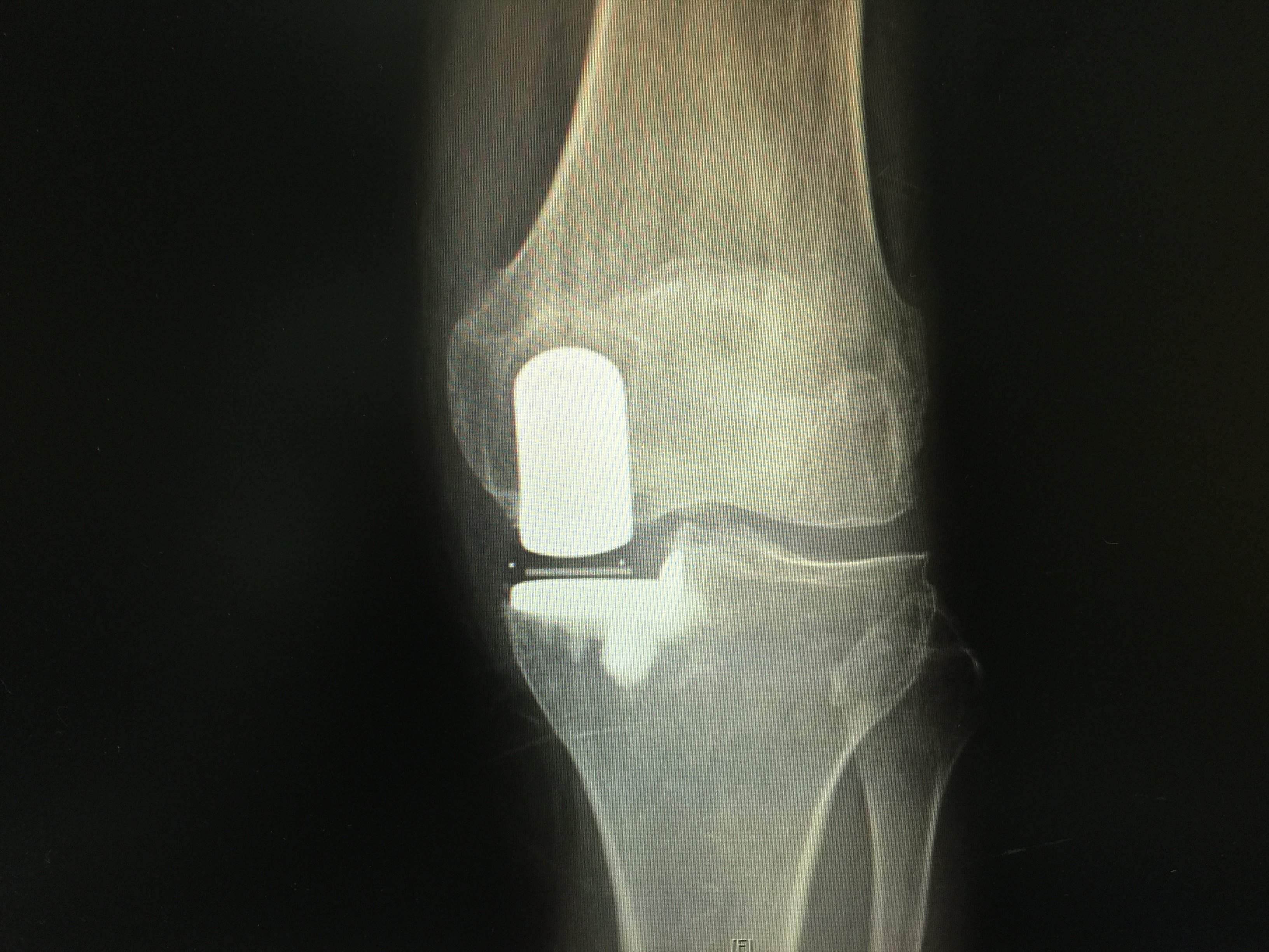 微创单髁关节置换术 - 好大夫在线