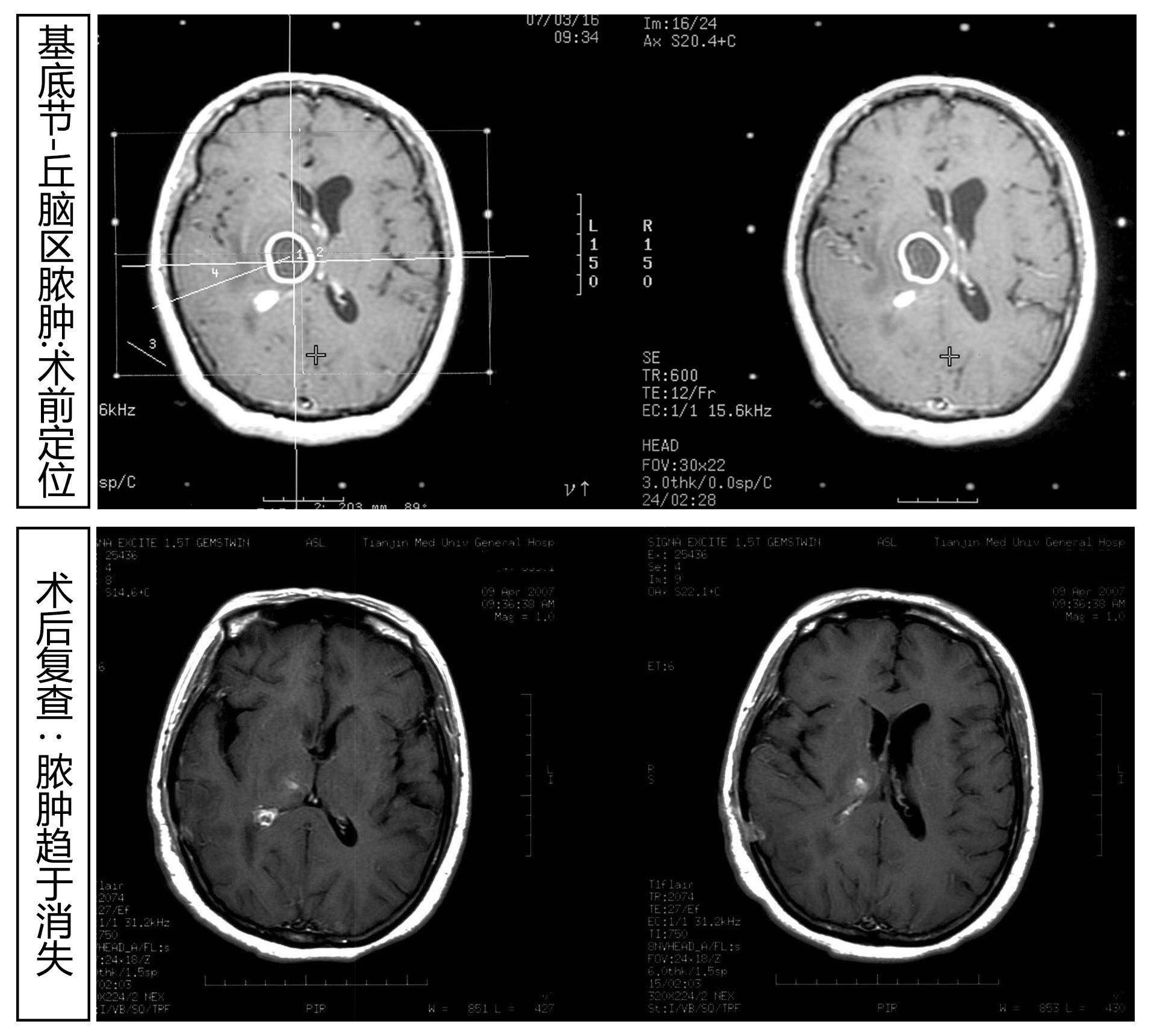 脑脓肿磁共振表现图像图片