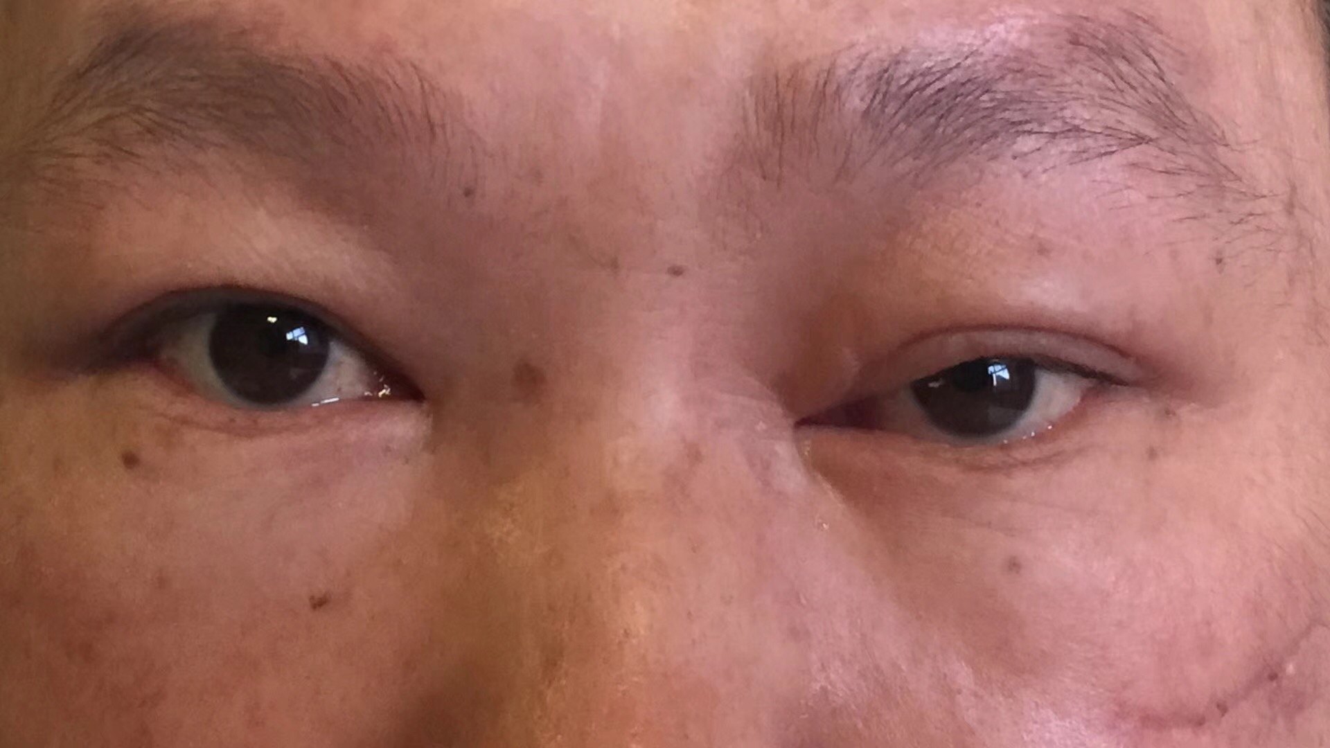 左动眼神经麻痹视神经损伤微创内镜术后改善 - 好大夫在线