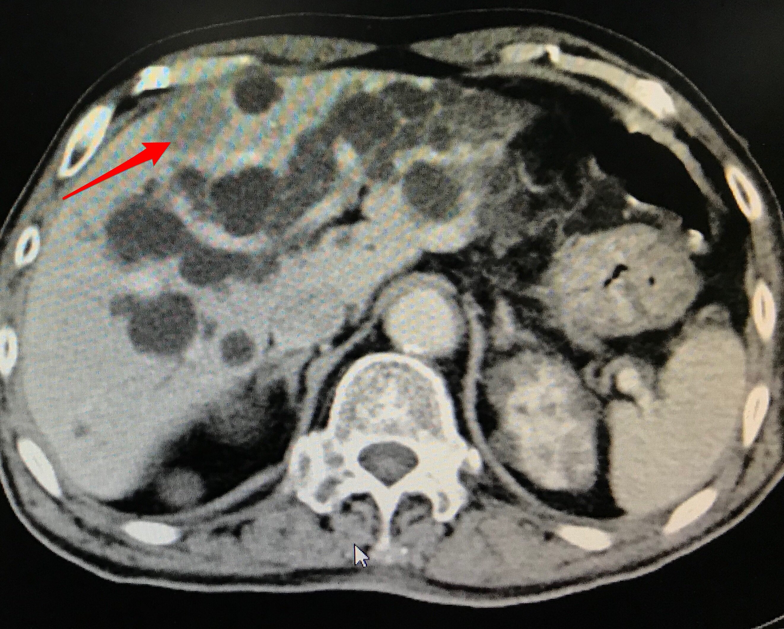 高龄患者肠癌肝转移灶的氩氦刀冷冻治疗案例分