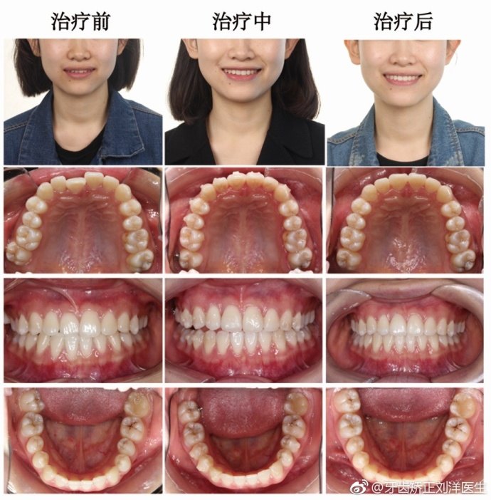 隐形矫正,您值得拥有!