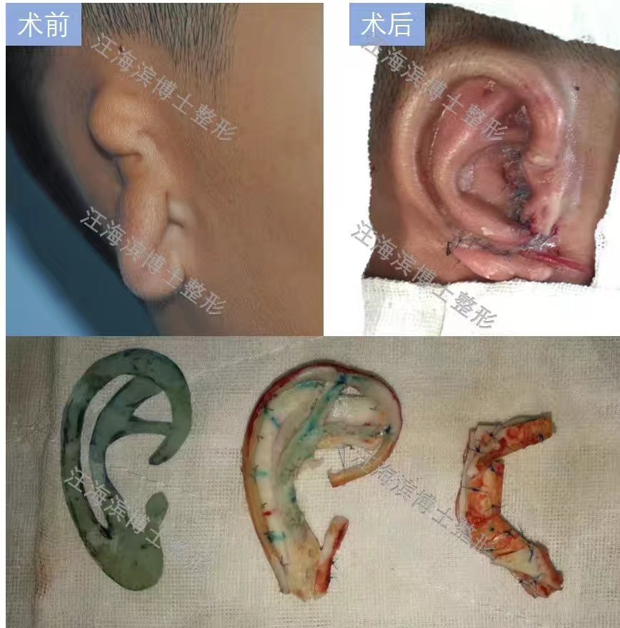 先天性小耳再造