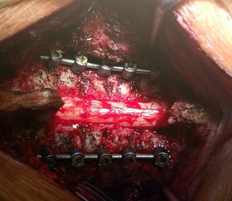 枢椎齿状突骨折手术图图片