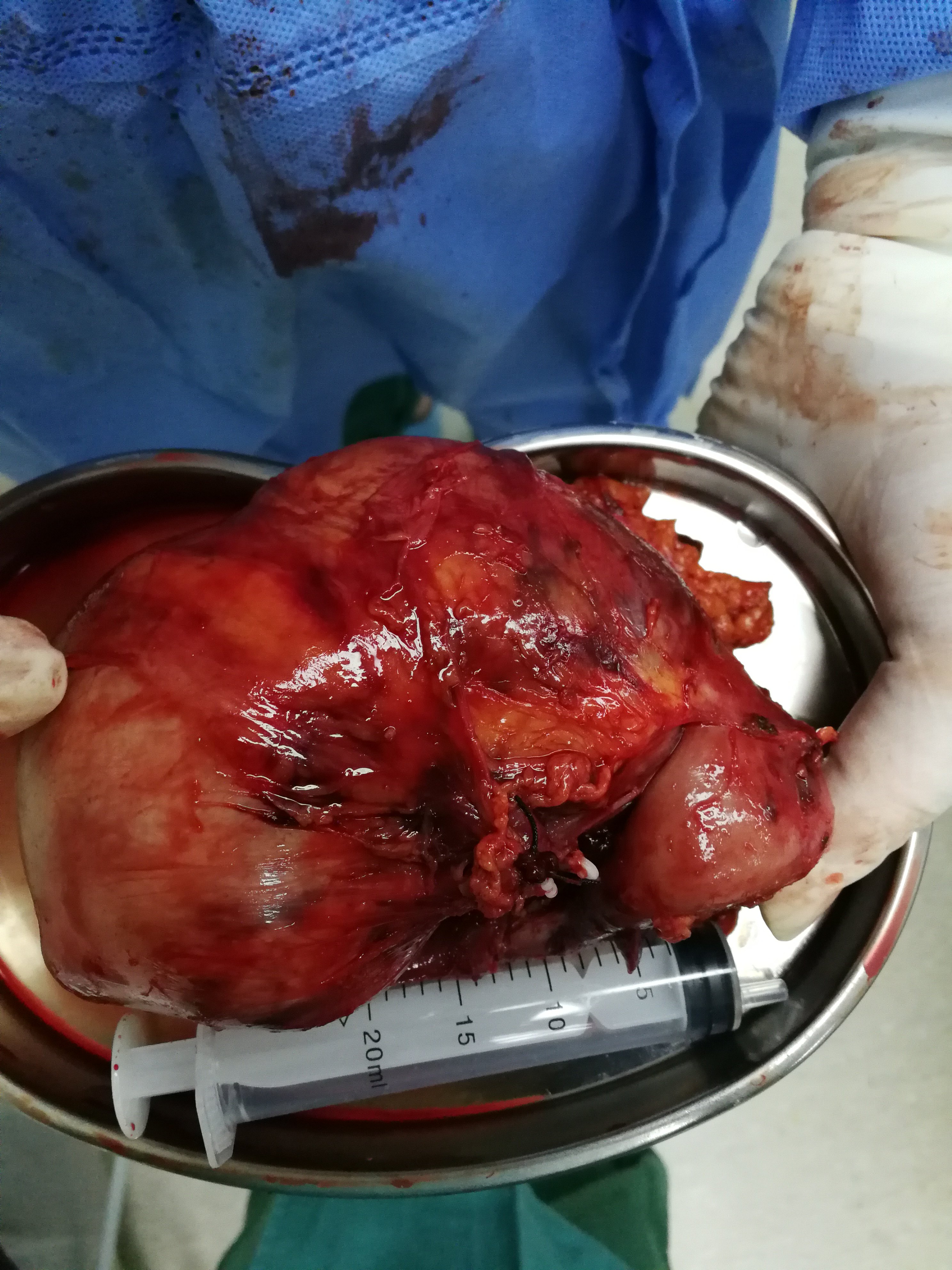 今日高难度手术:后腹腔镜下右侧巨大肾癌根治术 - 好大夫在线