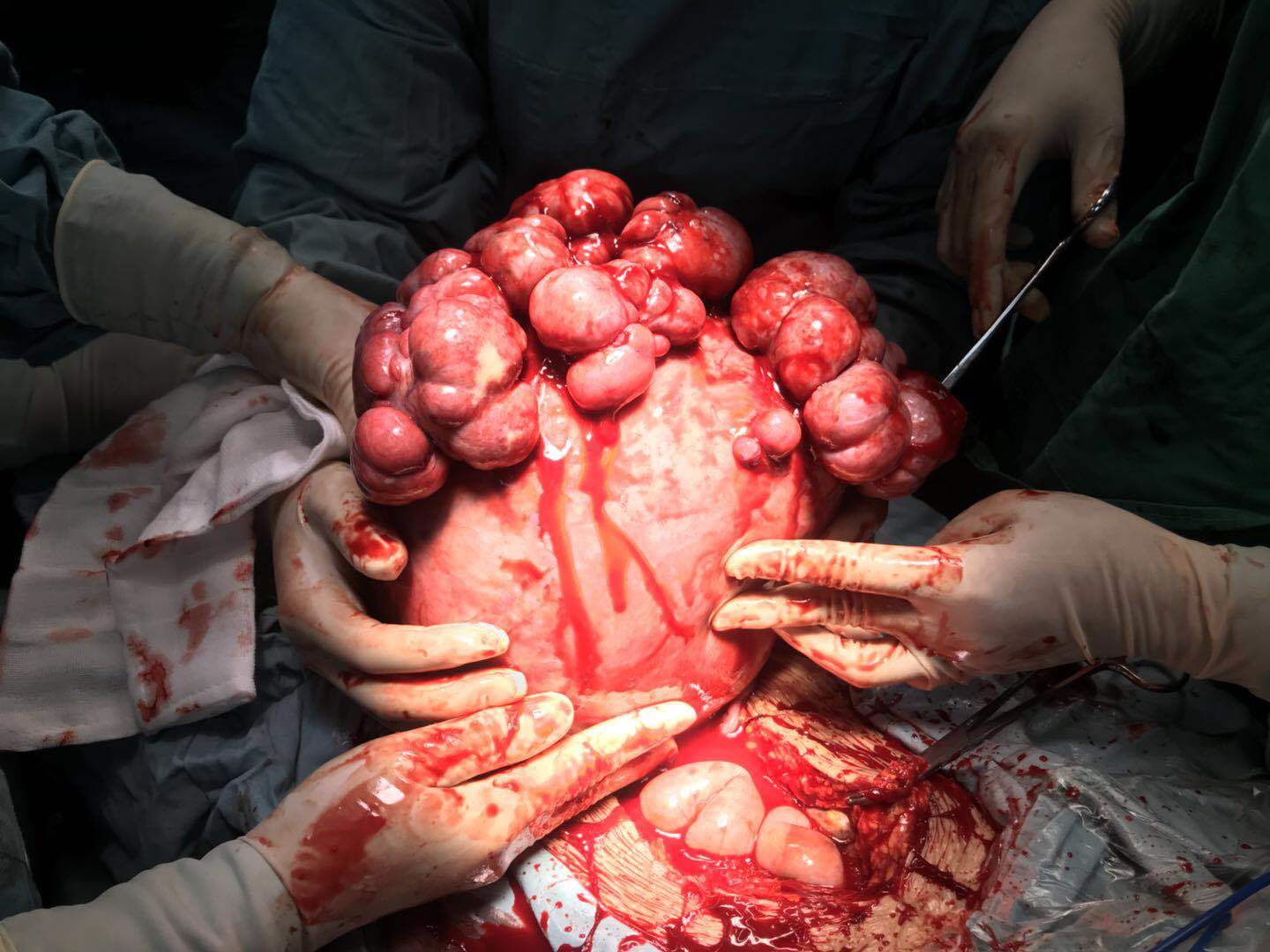 妊娠合并子宫肌瘤