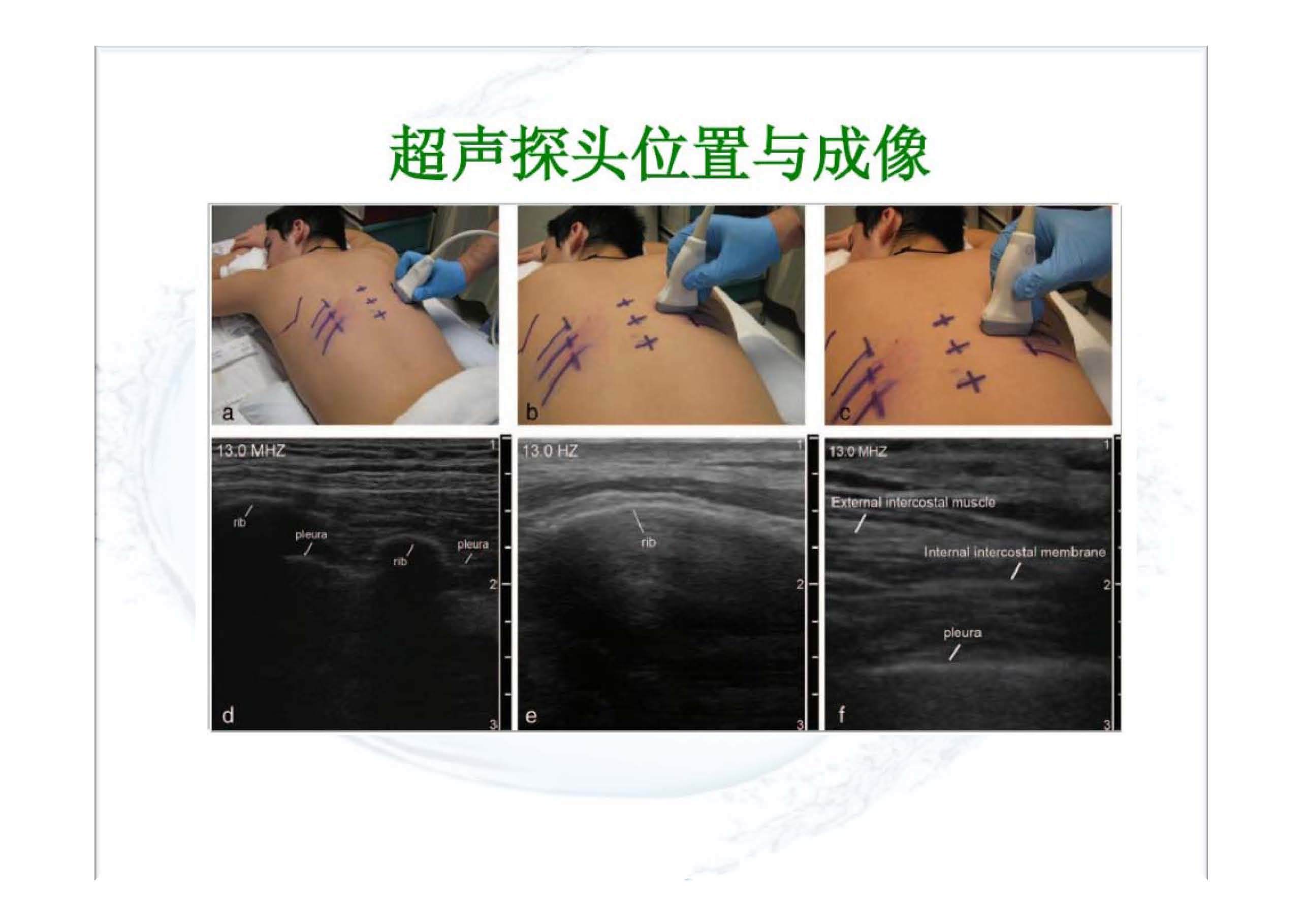 胸椎旁神经阻滞 超声图片