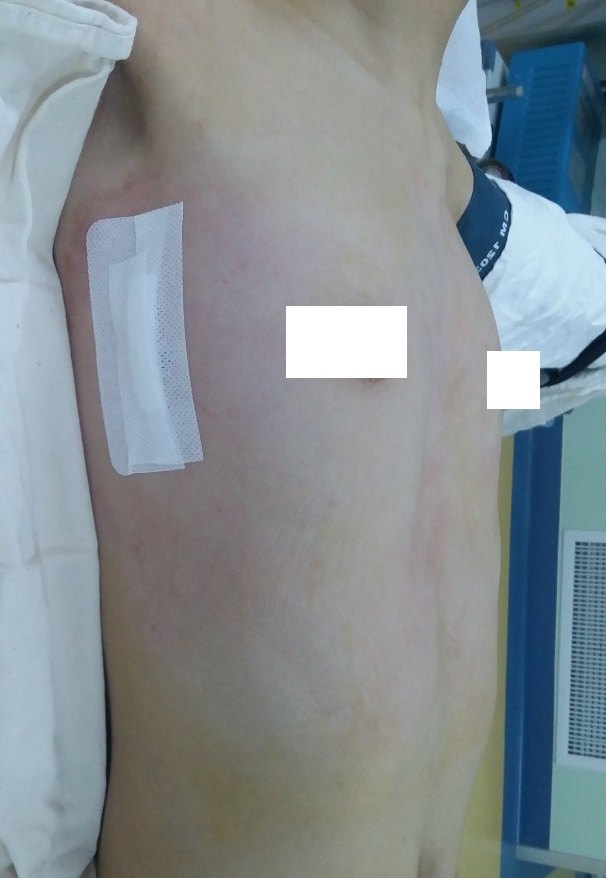 今天的鸡胸超微创手术:无管、无胸腔镜、微切