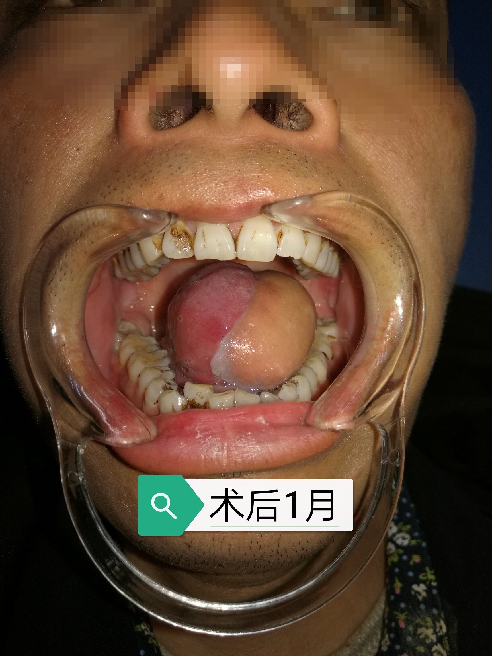 舌癌治疗方法图片