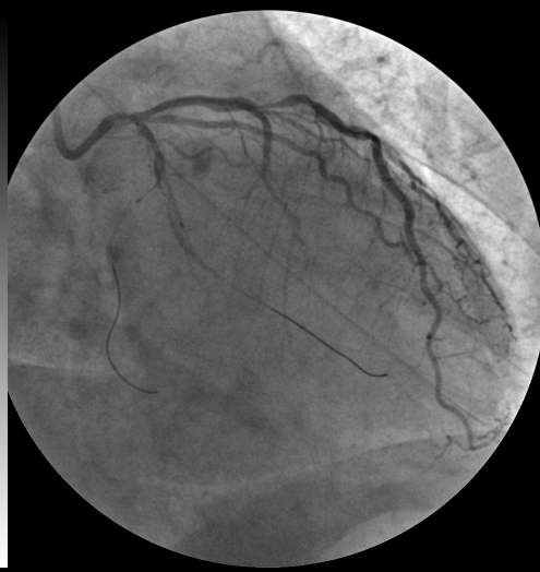 回旋支急性心肌梗塞一例