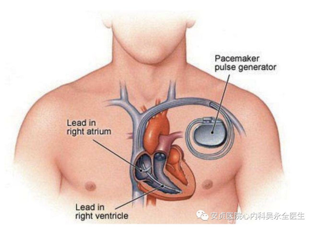 (图7 心脏起搏器示意图)2,希氏束起搏最初起搏器的导丝植入在右室心尖