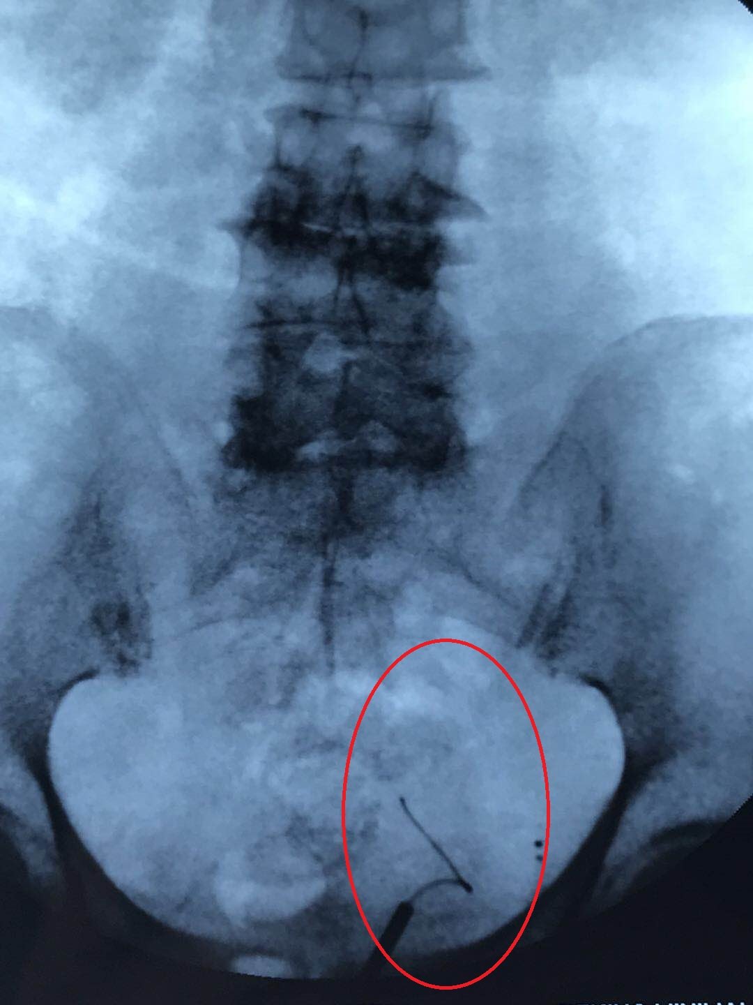 宫颈癌术后尿瘘微创处理