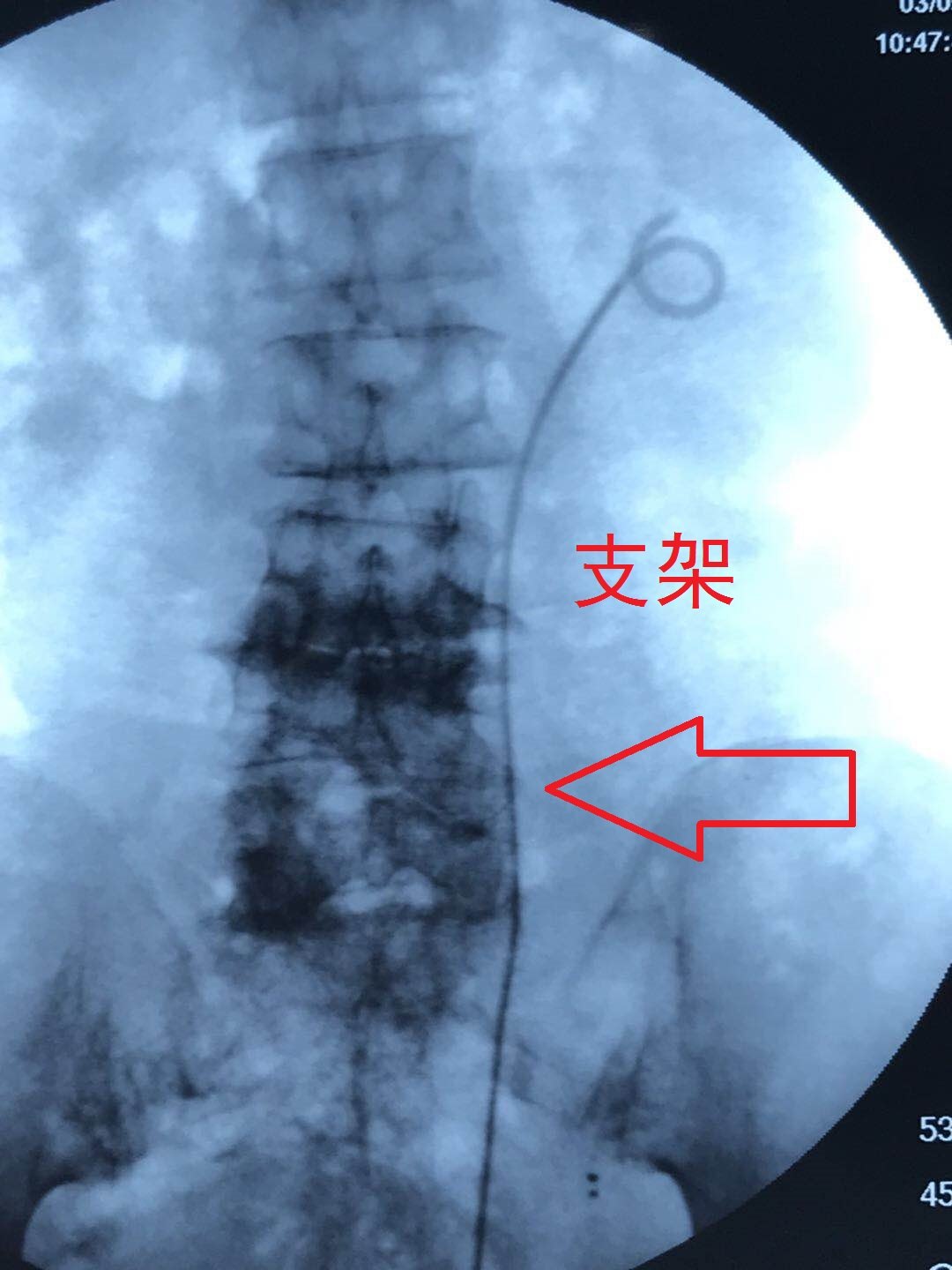 宫颈癌术后尿瘘微创处理