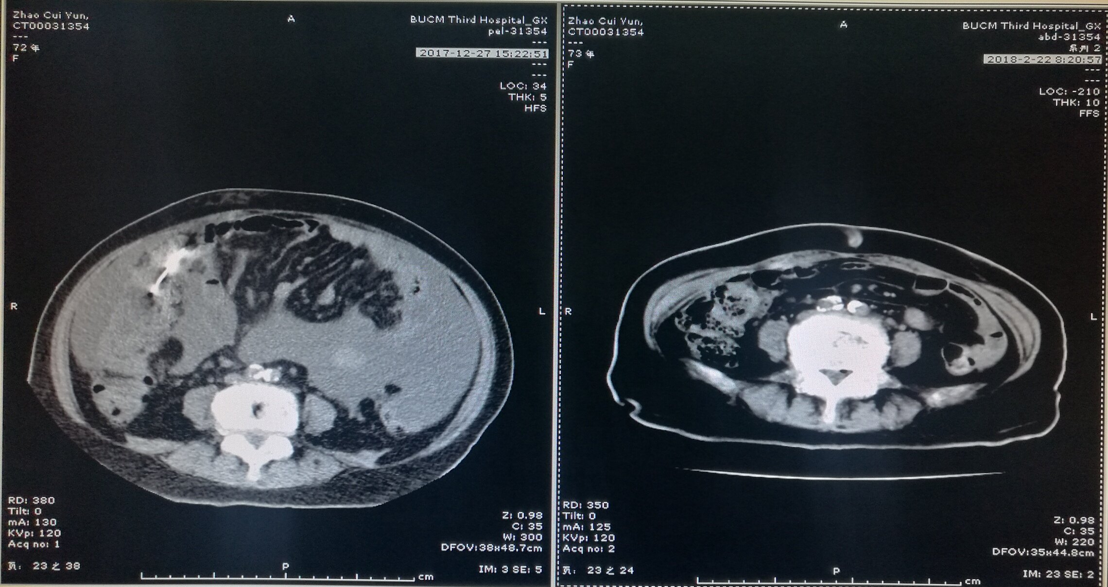 中西医治疗老年晚期卵巢癌至肿瘤影像消失并成功手术1例分享