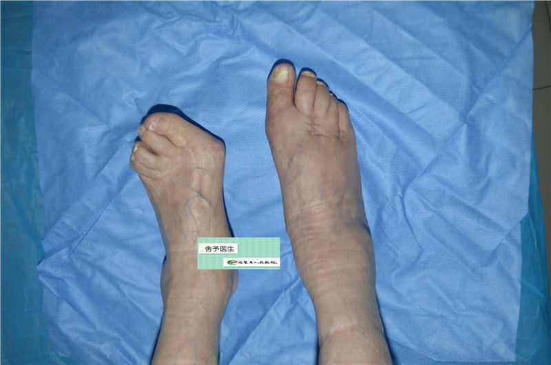 我院首例前足重建术治疗类风湿足 - 好大夫在线