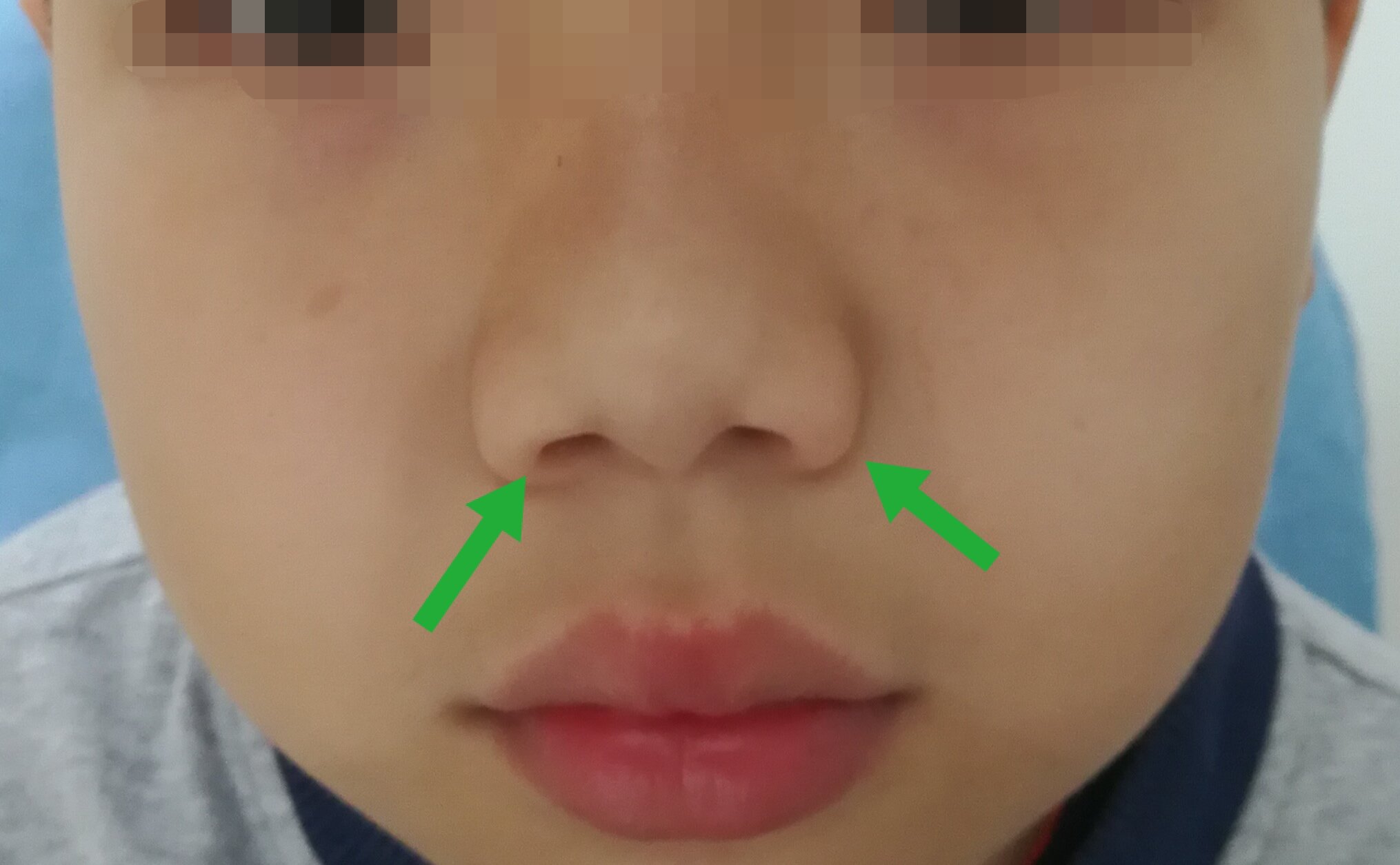 长期鼻炎可能会影响孩子的外貌 