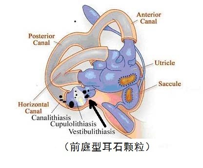 什么是前庭型耳石症?_内耳眩晕 - 好大夫在线