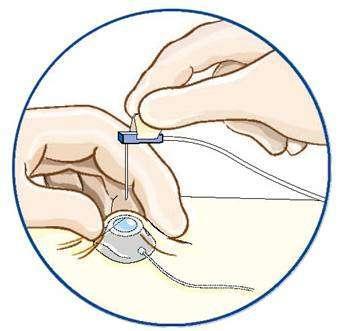 化疗使用输液港和锁穿的优劣? - 好大夫在线