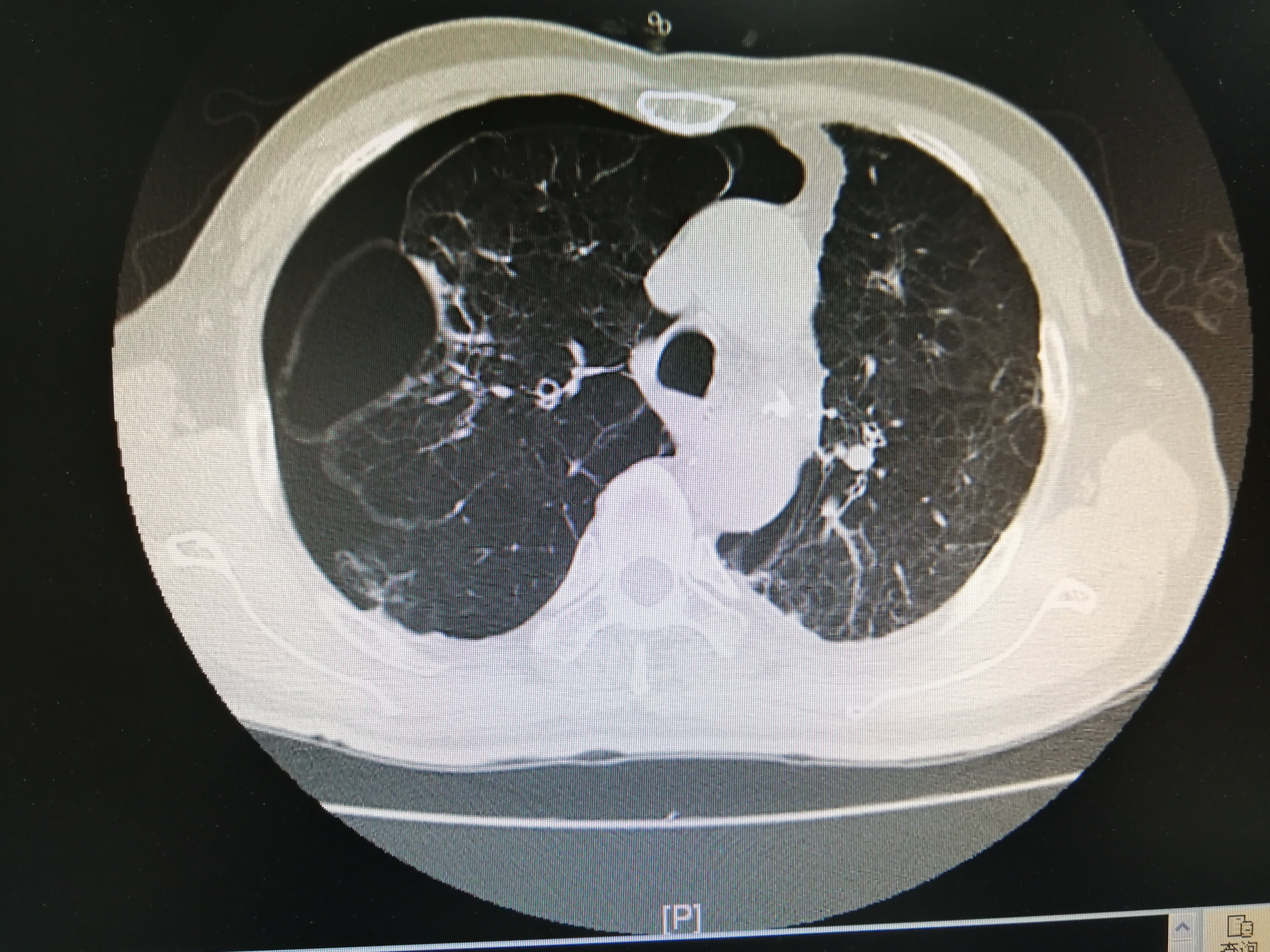 肺大泡x线表现图片图片