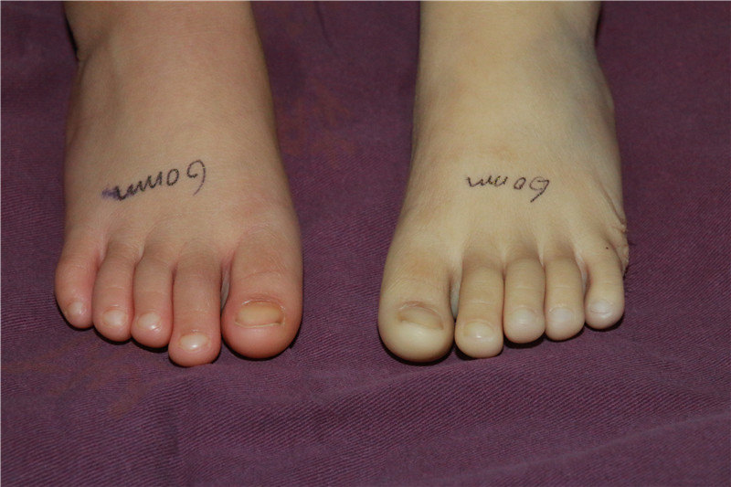 六趾畸形六个脚趾头迷信说法六趾畸形是什么原