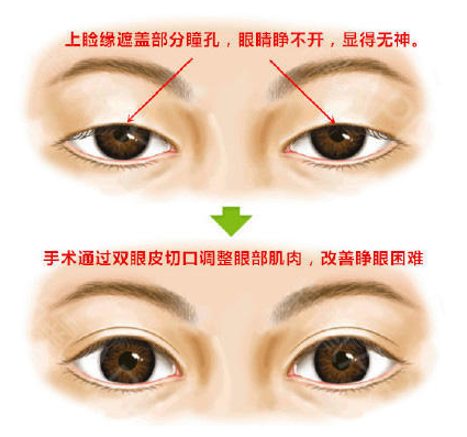 李斌斌手术实例——外眼角提升术详解及案例