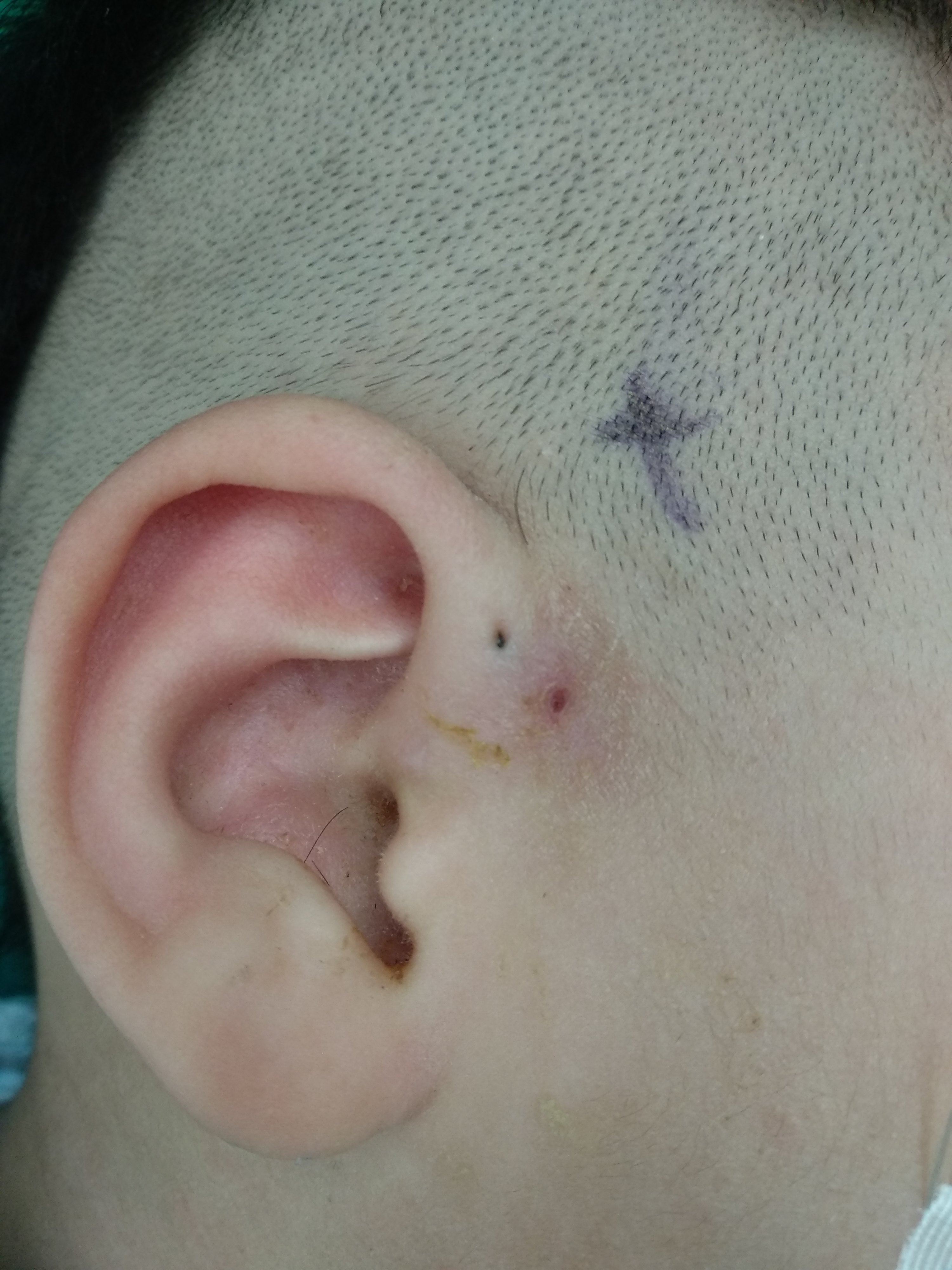 我终于做掉了我的先天性耳前瘘管 - 知乎