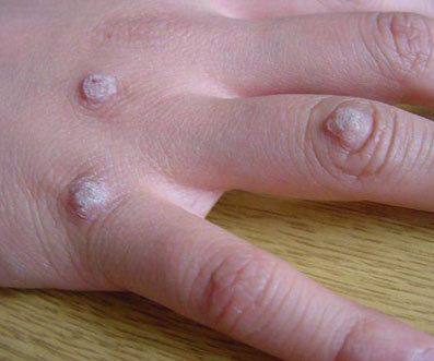 但是hpv是个大家族,现在已知的有200多个亚型,不同型的hpv导致的症状