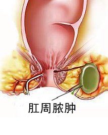 单纯切开引流术:适用于各种肛周脓肿,无一次性根治条件的病人4