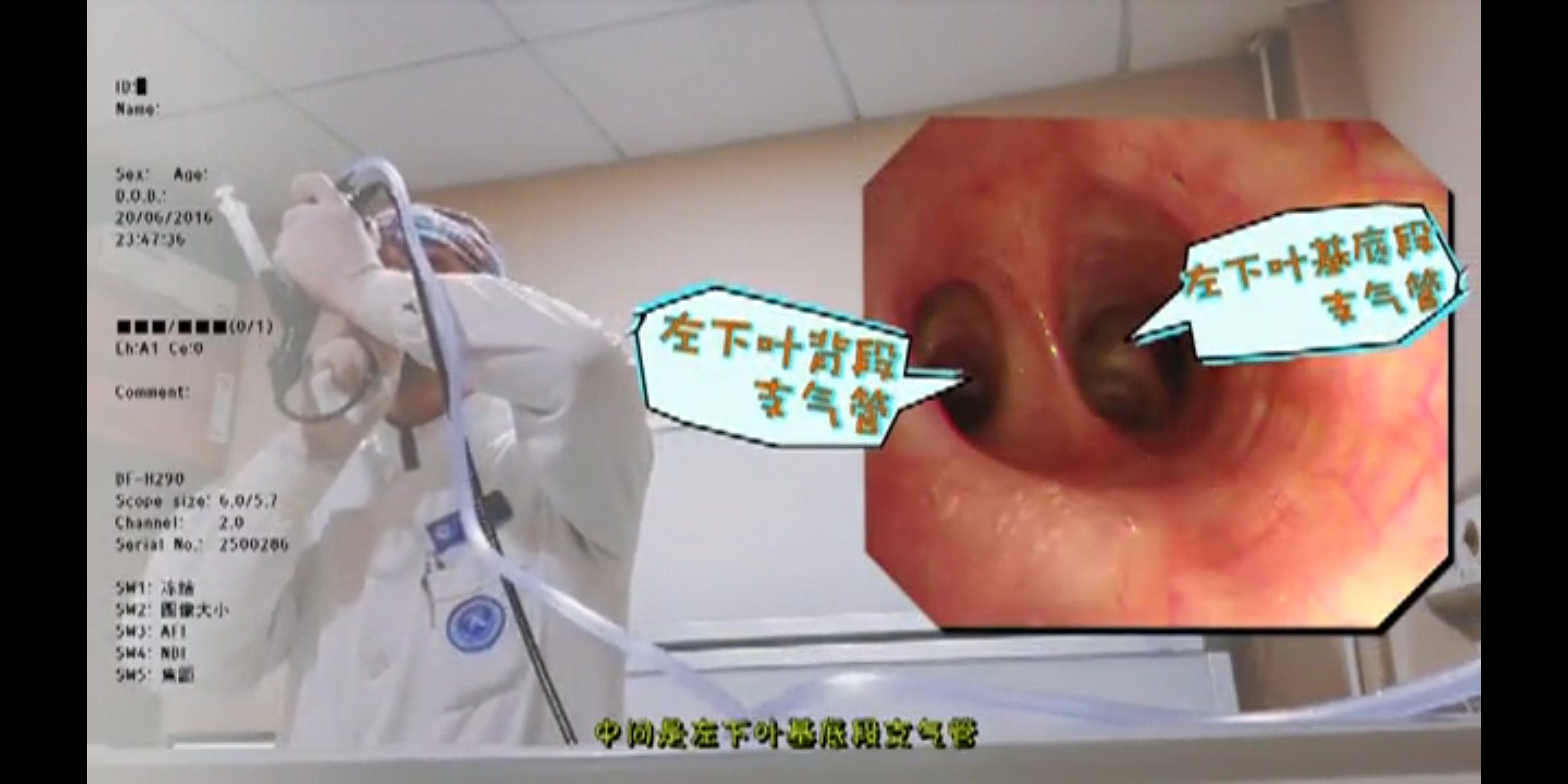 我来告诉你:支气管镜检查是否难受? - 好大夫在线