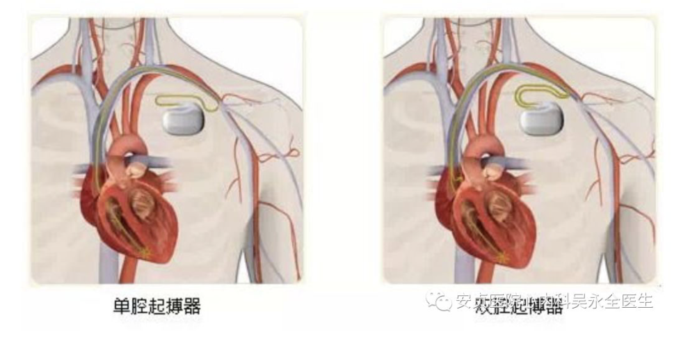 (图3单腔起搏器与双腔起搏器)3希氏束起博最初医生们将起搏器的导丝